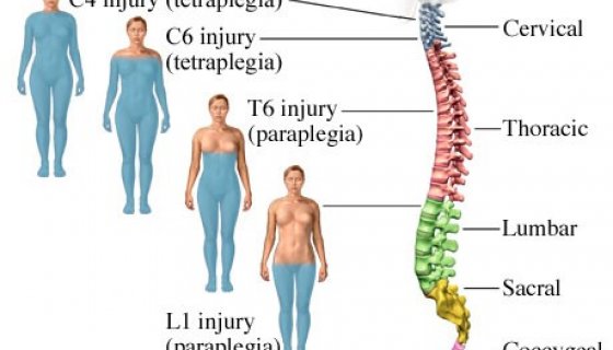 Parapleji
